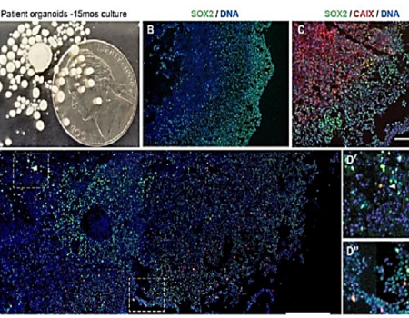 Análisis molecular de las quimiocinas y sus receptores para evaluar el potencial metastásico en células de cáncer de mama usando trampas celulares in vitro e in vivo